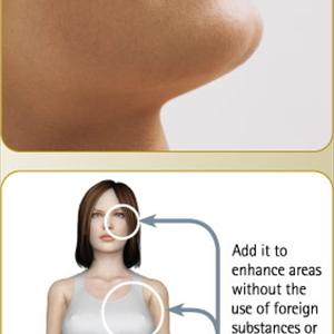 Breast Augmentation Procedure 