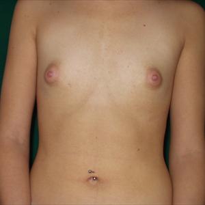 Breast Enlargement In Uk - Breast Reduction Surgery - From Pre-Operation To Full Recovery