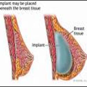  Breast Enhancement & Breast Enlargement Guides