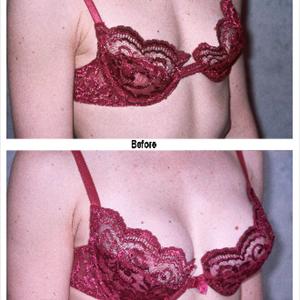 Breast Enlargement Gold Coast - Herbal Breast Enhancers - A Natural Solution